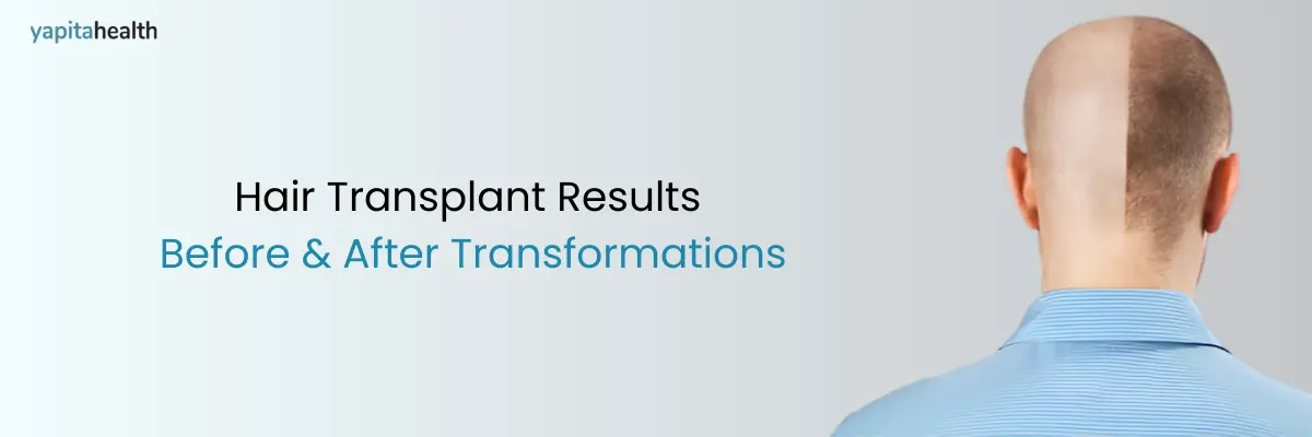 Hair Transplant Results: Before & After Transformations