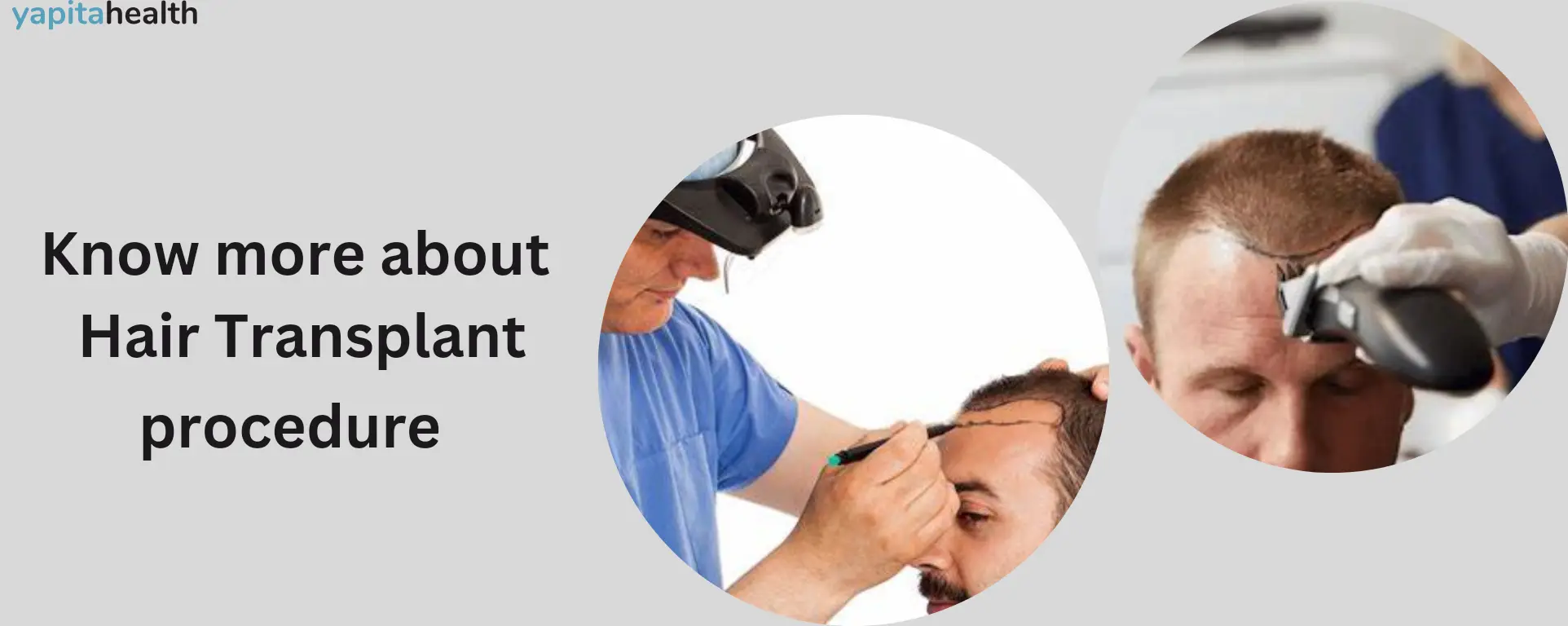 10+ Side effects of Hair transplants - Complete Guide to the Downside of Hair Transformation