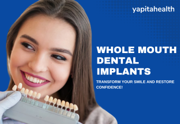Whole Mouth Dental Implants 