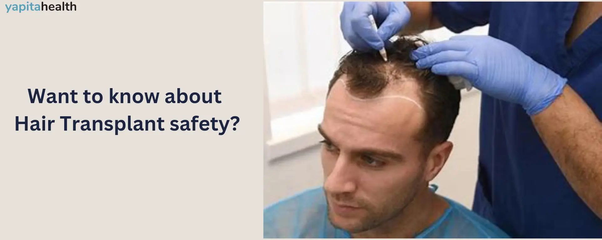 Are Hair transplants Permanent and Safe?