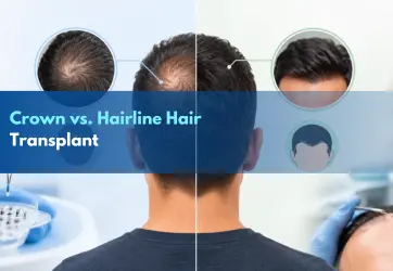 Crown vs. hairline hair transplant