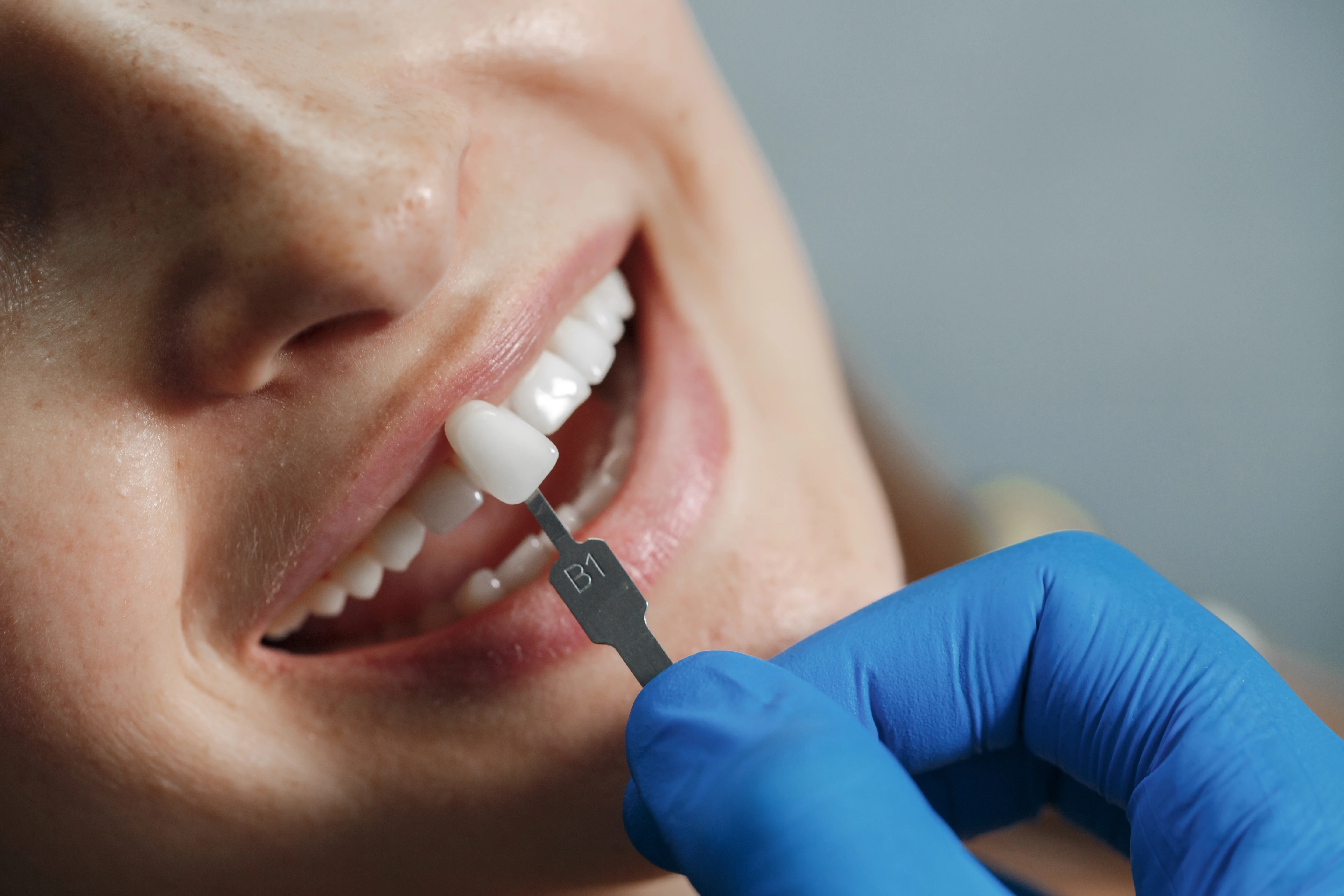 Les facettes Emax en Turquie sont des alternatives populaires aux facettes en zirconium ou composite