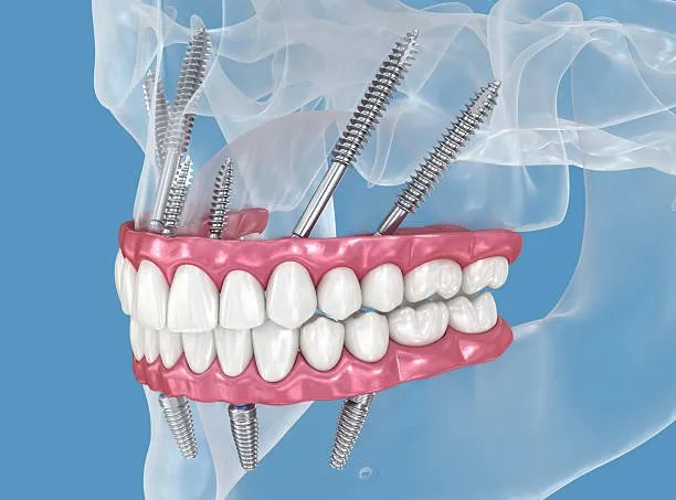 Zygomatische Implantate helfen Patienten, Knochenaufbau zu vermeiden