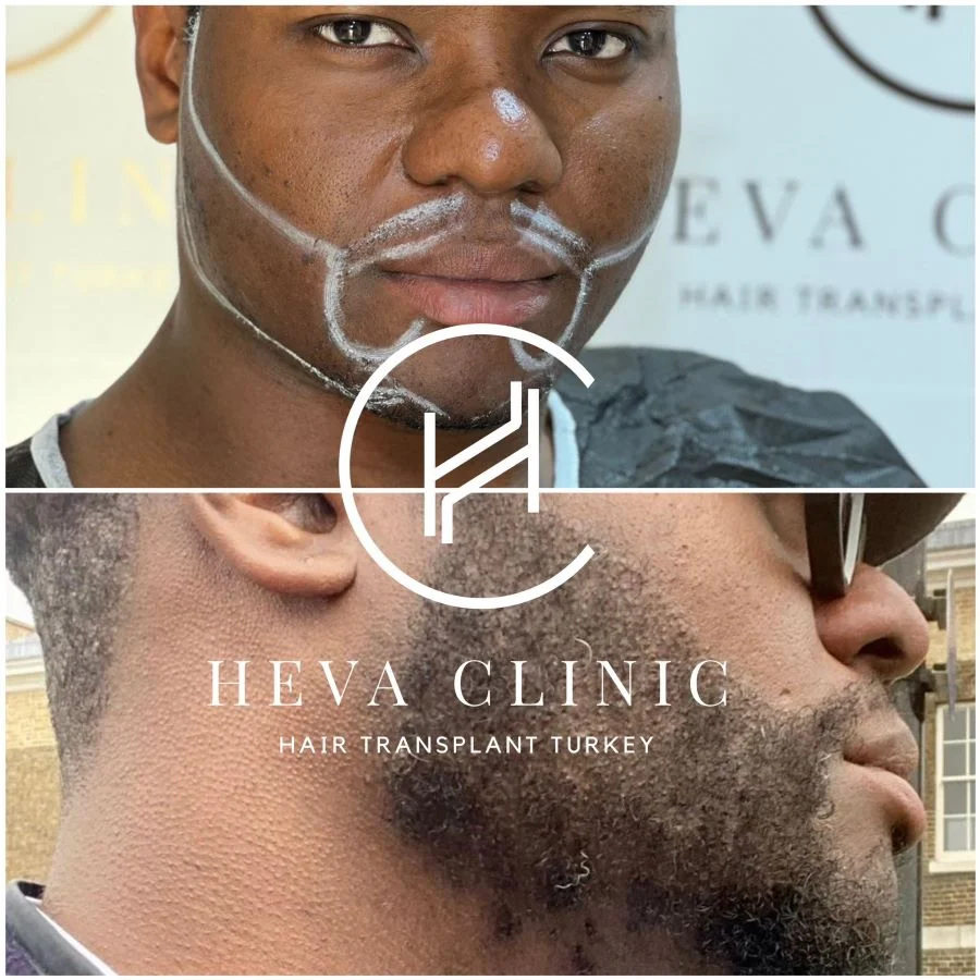 transplant barbă afro Heva clinic 2800 grefe