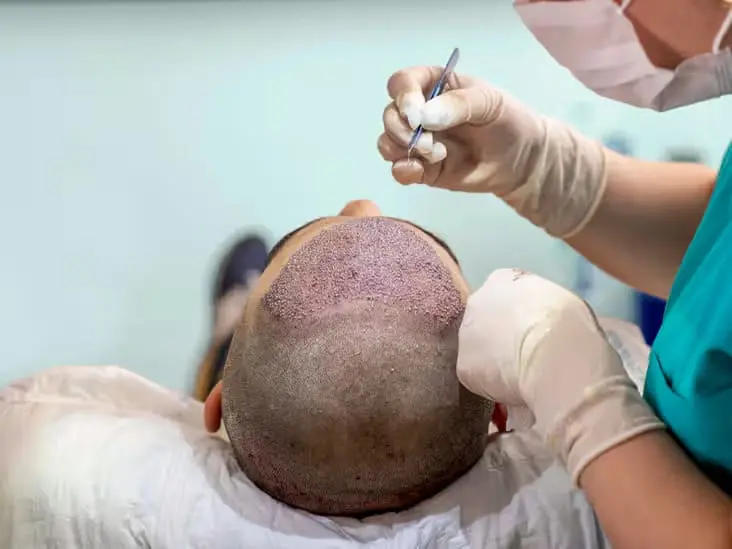 hair transplant process
