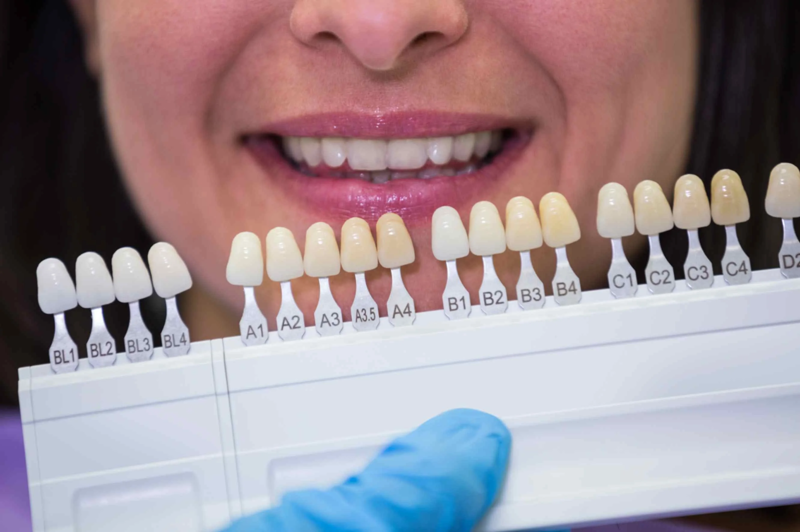 16 E-Max Veneers Turkey
