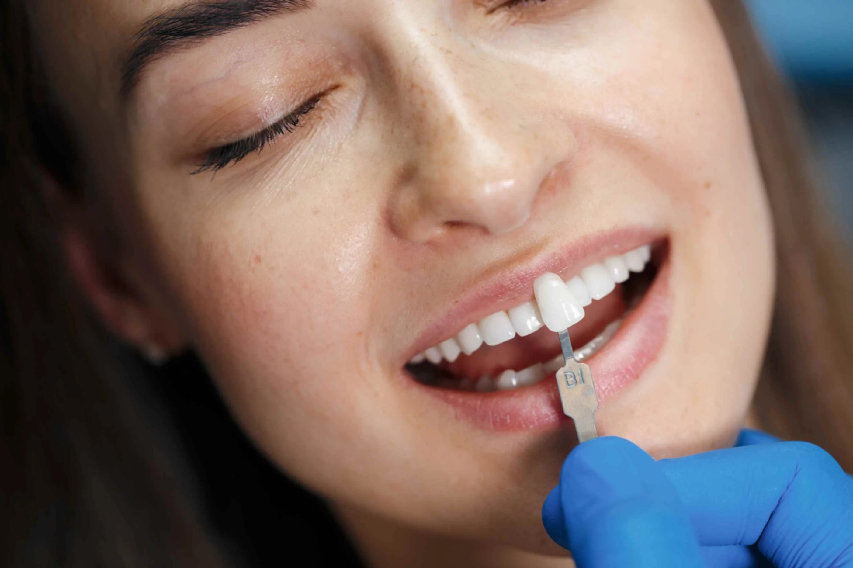 8 E-Max Veneers Turkey