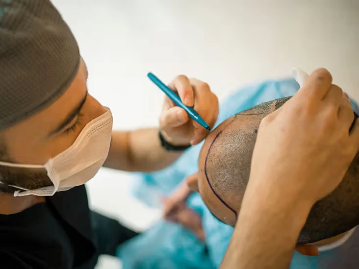 process of hair transplant